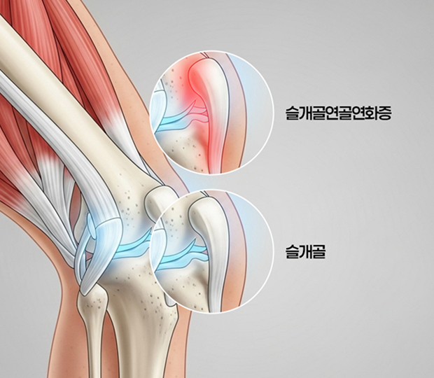 슬개골연골연화증