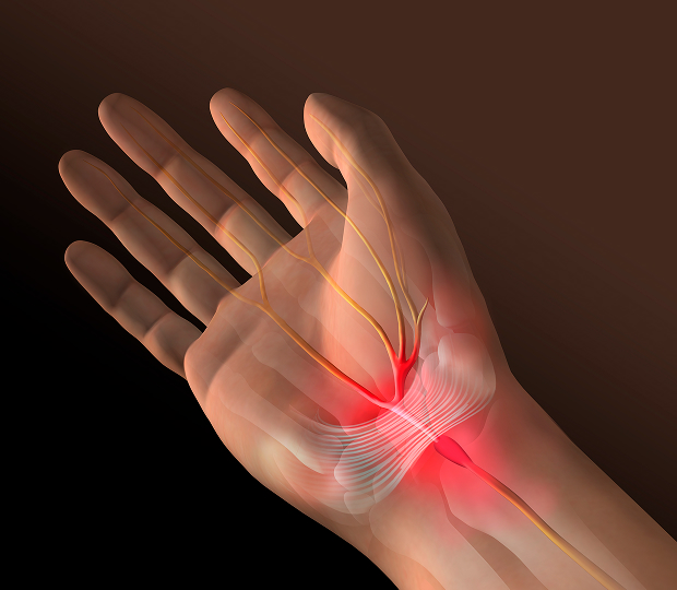손목터널(수근관)증후군